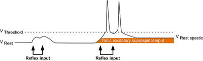 Sound-Evoked Biceps Myogenic Potentials Reflect Asymmetric Vestibular Drive to Spastic Muscles in Chronic Hemiparetic Stroke Survivors